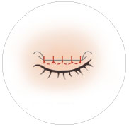 매몰식쌍꺼풀 쌍꺼풀을 만드는 단계