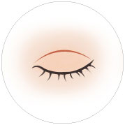 절개식 쌍꺼풀 절개선