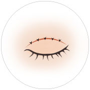 절개식 쌍꺼풀 봉합