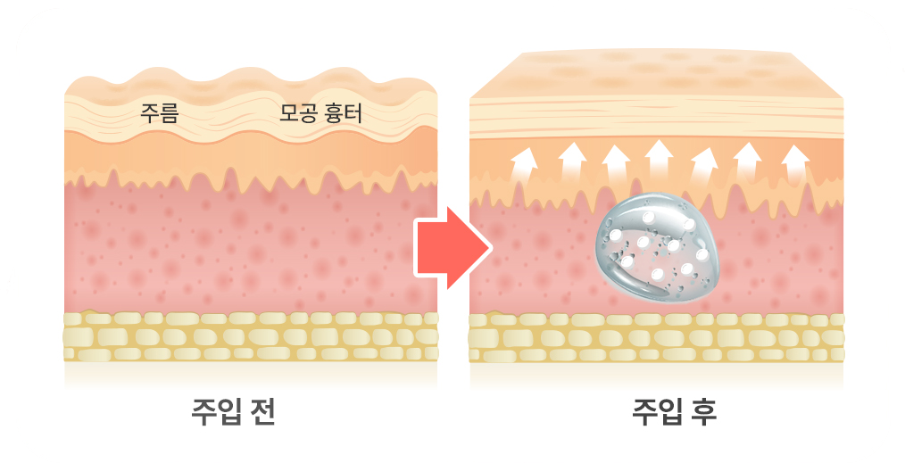 리투오 주입 전후 볼륨 효과