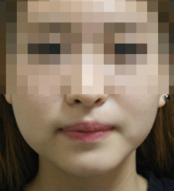 브이라인주사 전후사진 Before