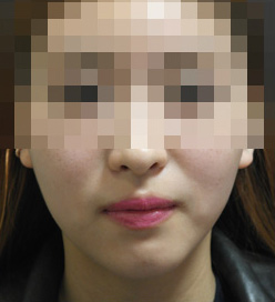 브이라인주사 전후사진 After